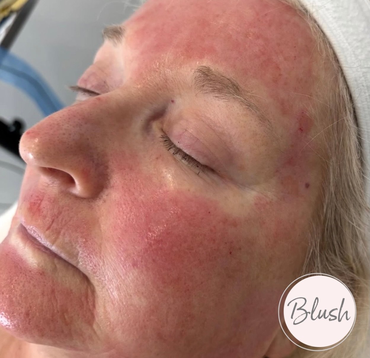 This wonderful client had VAMP Microneedling done. 

This is a before and after photo of the reduced redness and downtime after she added on the CO2 Lift Mask! ✨

𝐖𝐡𝐚𝐭 𝐢𝐬 𝐚 𝐂𝐎𝟐 𝐥𝐢𝐟𝐭 𝐦𝐚𝐬𝐤?

A CO2 lift mask is a medical grade carboxy 