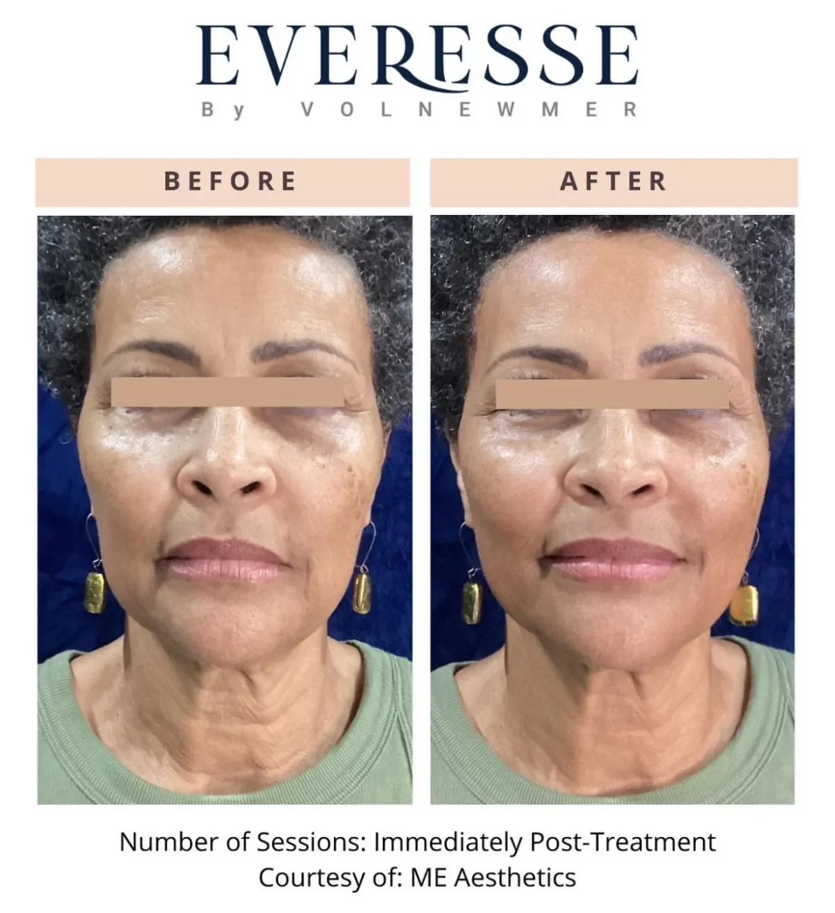Medspa in Long Beach, CA, 90808 | Everesse™ Monopolar Radiofrequency Near Me