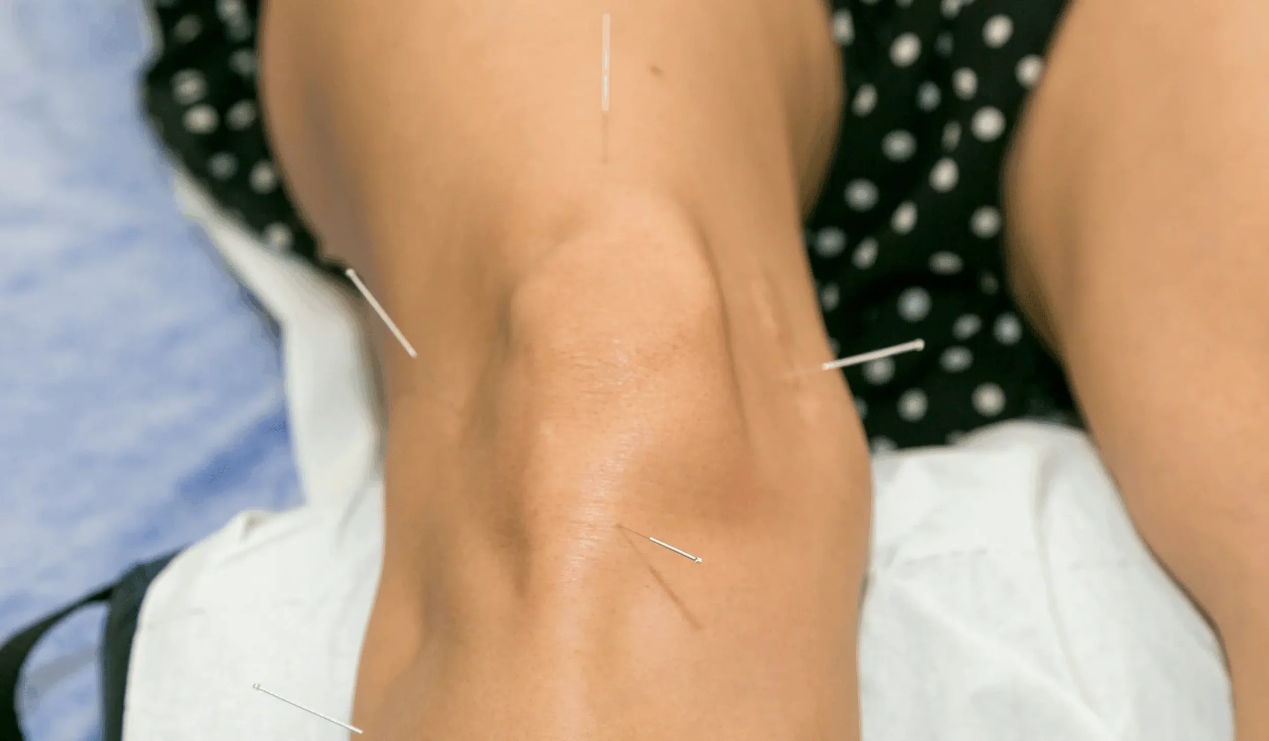 Acupuncture in Winchester
