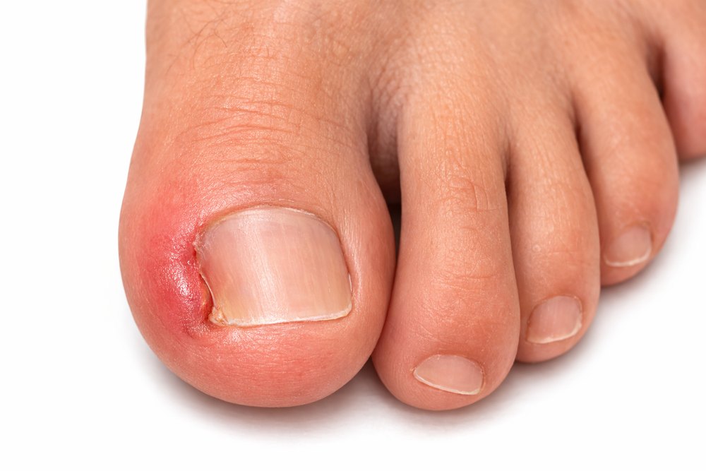 Ingrown toenail treatment in Salt Lake City