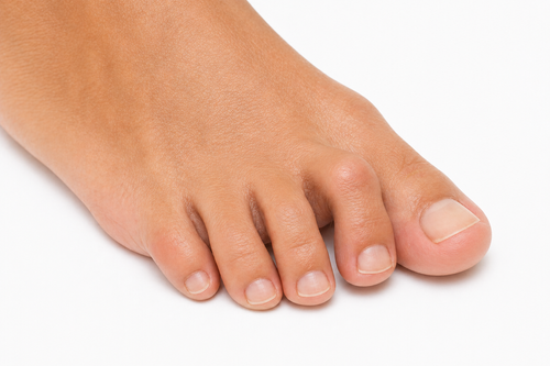 Hammertoe treatment for painful bent toes in Salt Lake City