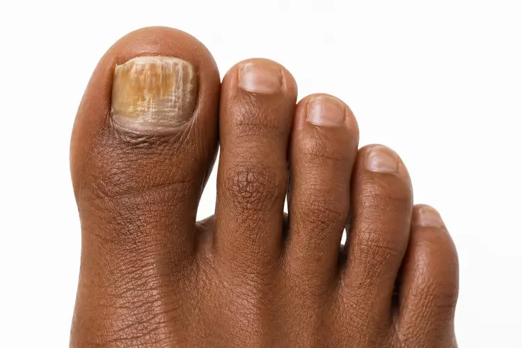 Toenail fungus treatment in Salt Lake City
