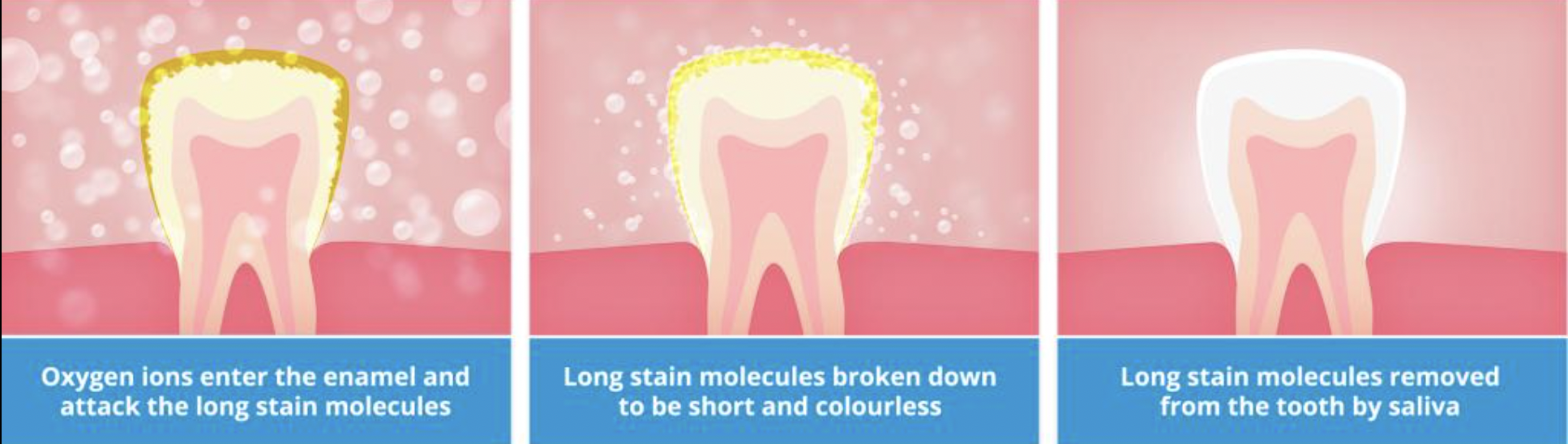 images of how whitening works on enamel to break down stains