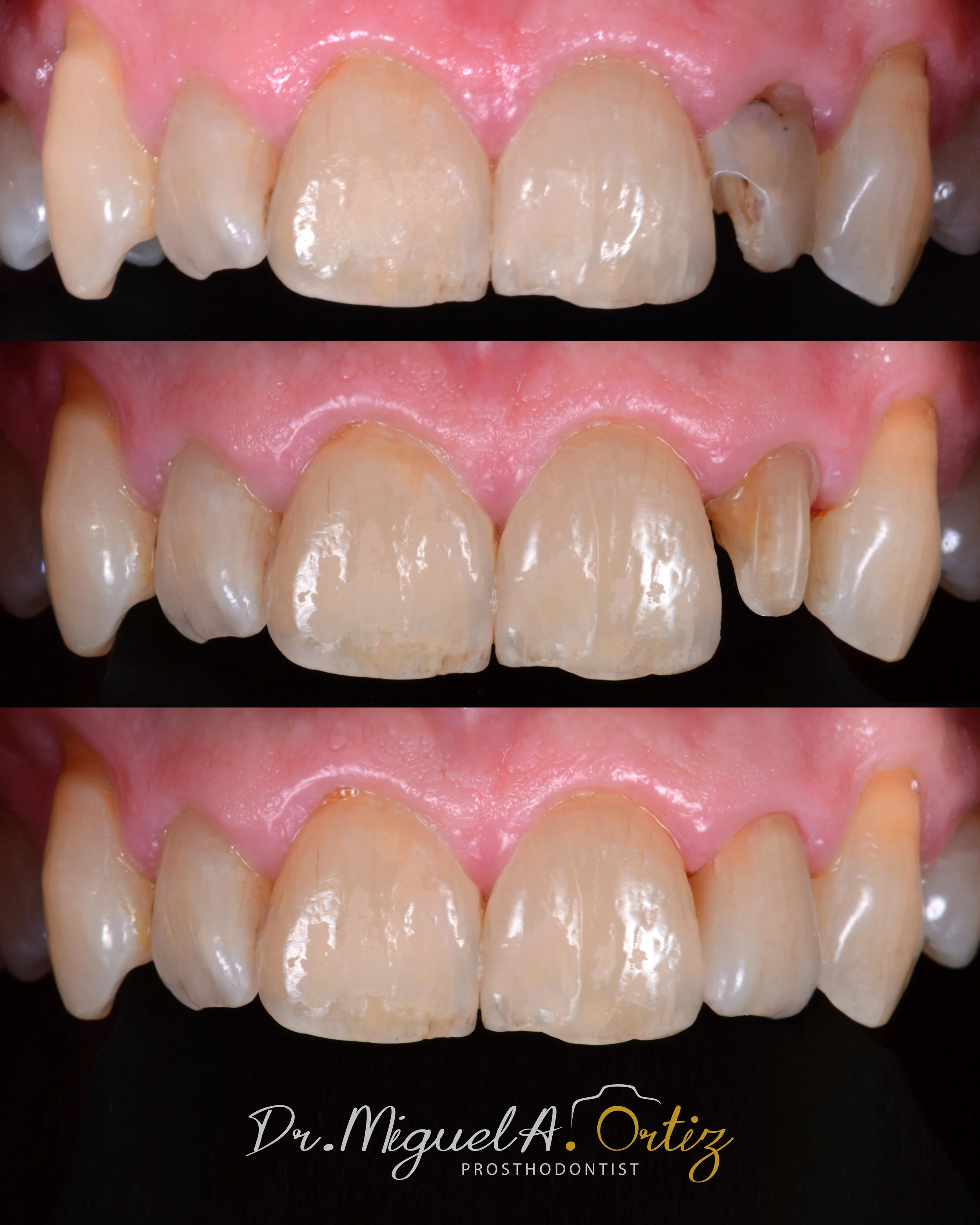 before and after crown with shade matching to existing teeth