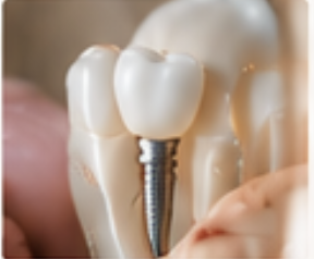 dental implant model