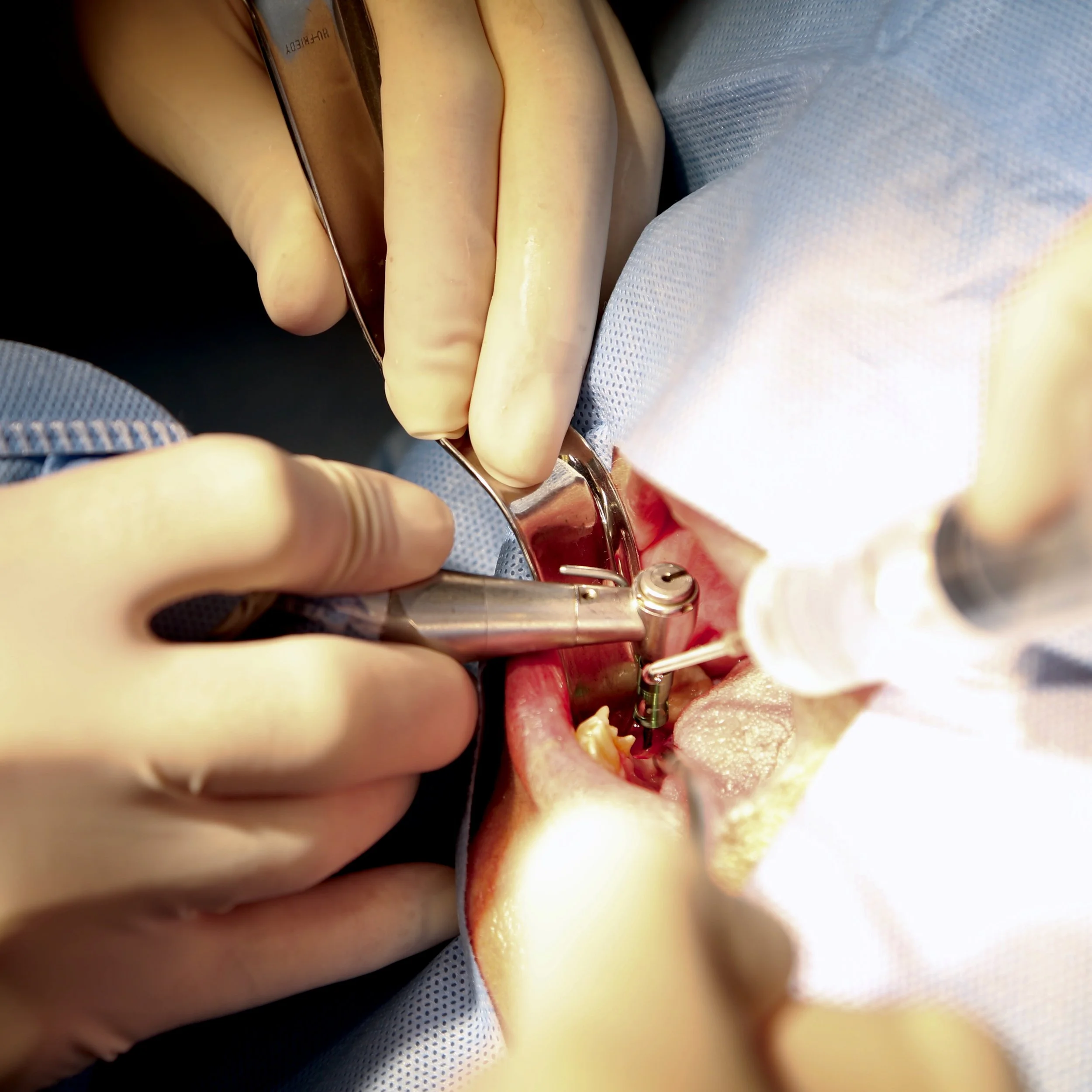 Implantes dentales para volver a comer y sonreír