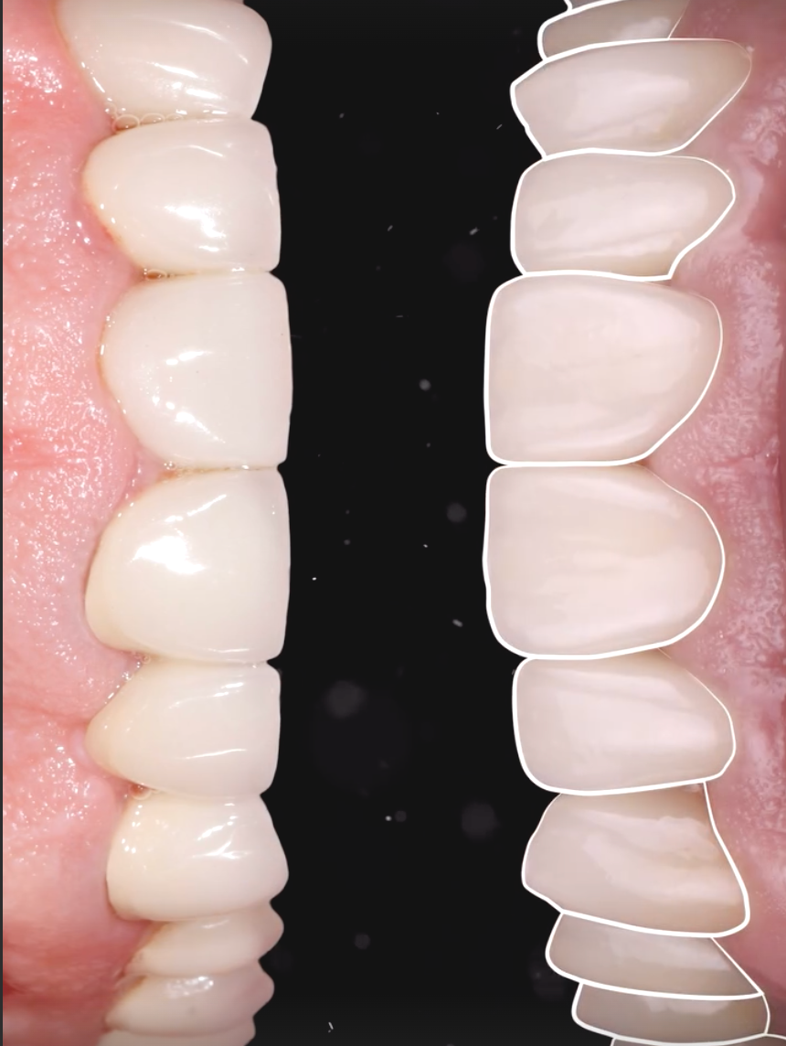 Diseño de sonrisa con criterio clínico y naturalidad 