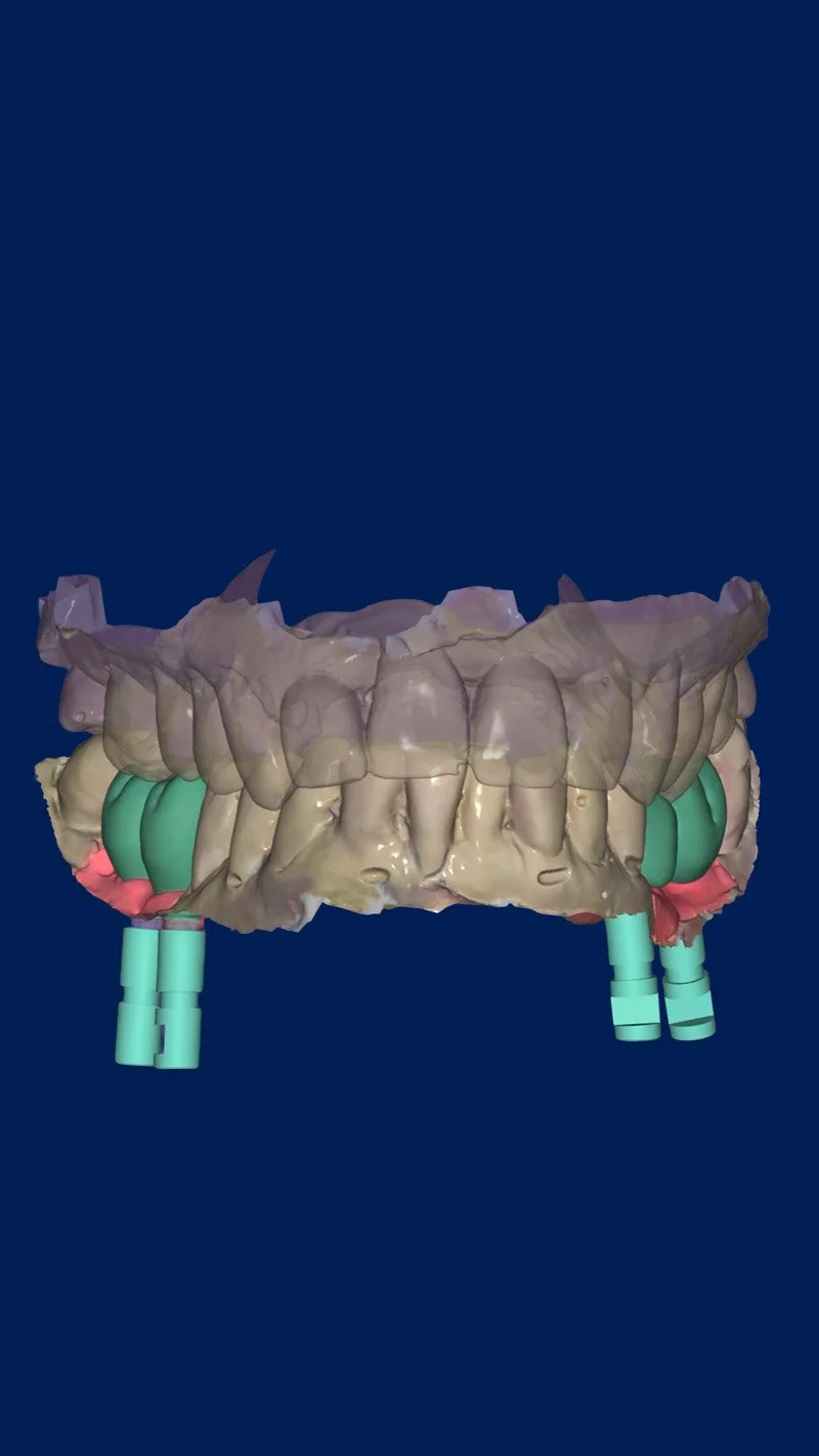Modelo digital de la mandíbula humana, mostrando dientes y estructuras óseas en diferentes colores.