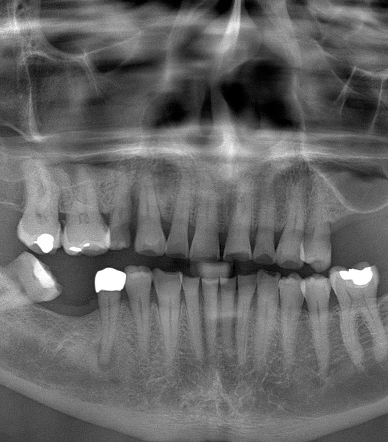 Radiografía dental muestra dientes y estructura ósea de la mandíbula y maxilar
