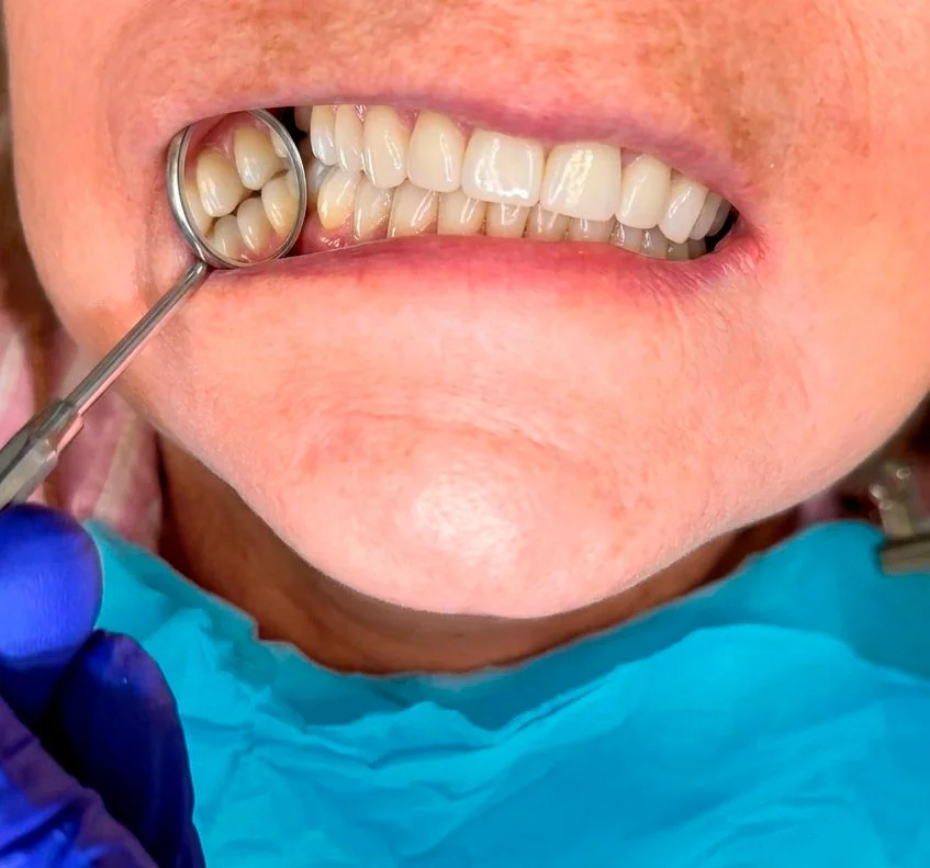 Paciente en consulta dental durante revisión de los dientes con espejo dental.