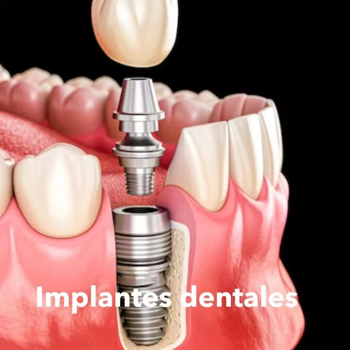 22 Implantes dentales Full Dentista.jpg