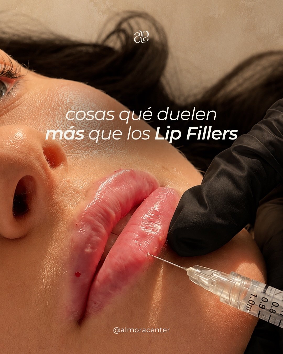 Los lip fillers quedaron fuera de la lista💋✨

&iquest;Mito o realidad? Agenda una cita y descubre si este procedimiento es para ti
.
.
.
#lipfillers #aumentodabioa #medicinaestetica #beautylips  #acidohialuronico