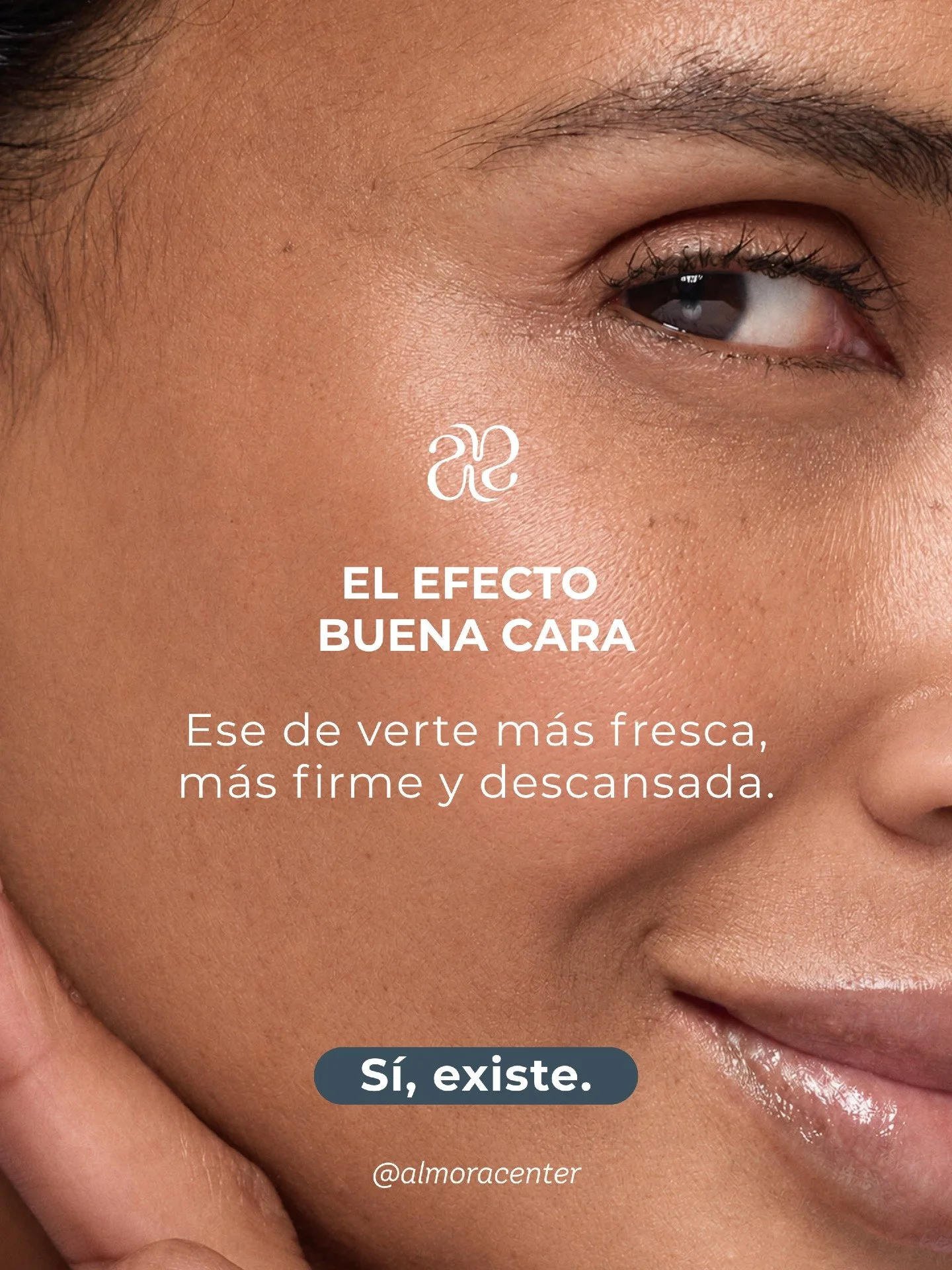 Este 23 de octubre, en Almora, descubre nuestra promoci&oacute;n especial en RADIESSE y dale a tu piel el cuidado que merece.

RADIESSE es un bioestimulador que favorece la producci&oacute;n de col&aacute;geno y elastina, ayudando a mejorar la firmez