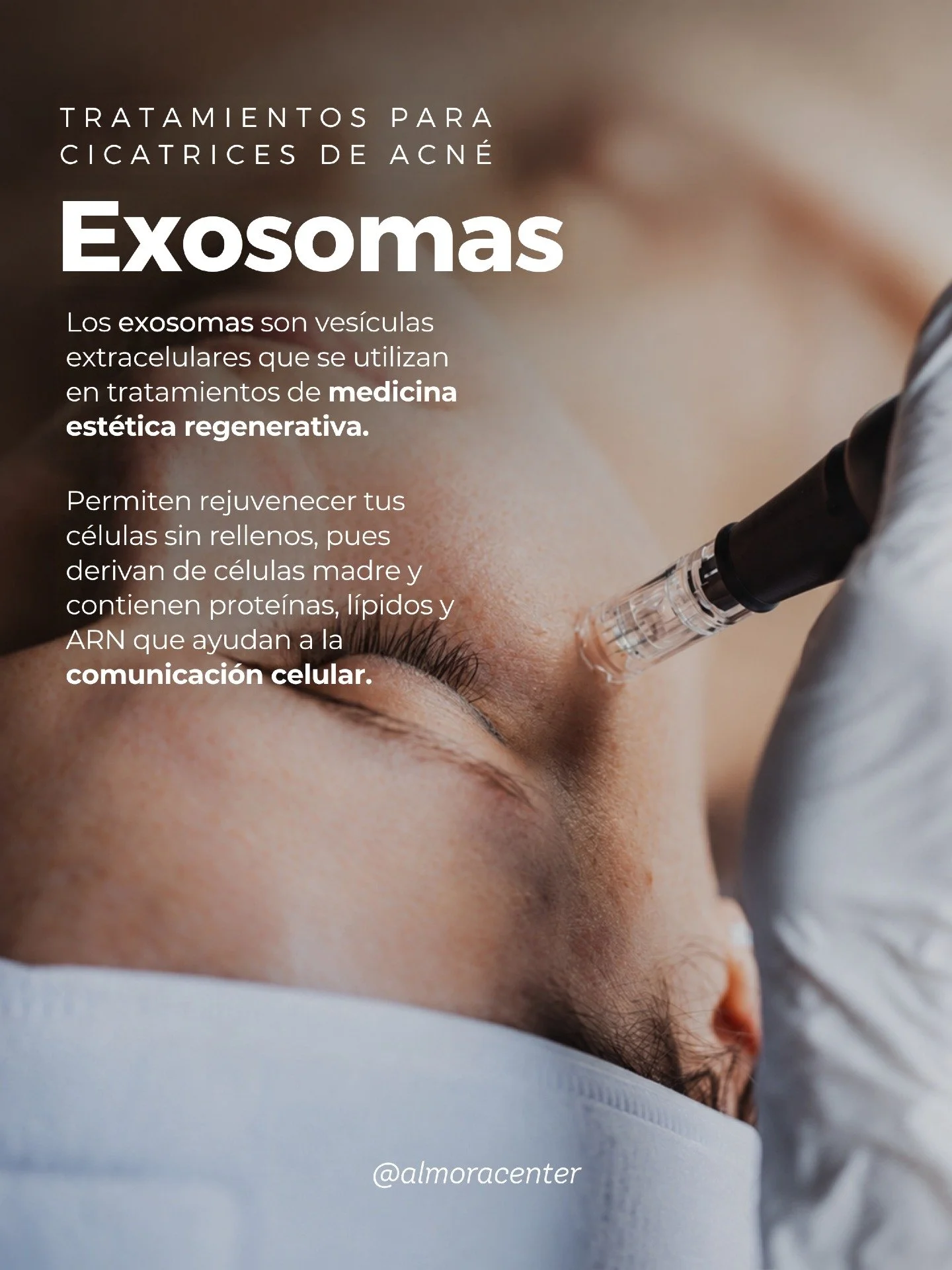 &iquest;QU&Eacute; SON LOS EXOSOMAS?
Medicina regenerativa 🧬

Los exosomas son ves&iacute;culas extracelulares utilizadas en tratamientos de medicina est&eacute;tica regenerativa.

Derivan de c&eacute;lulas madre y contienen prote&iacute;nas, l&iacu