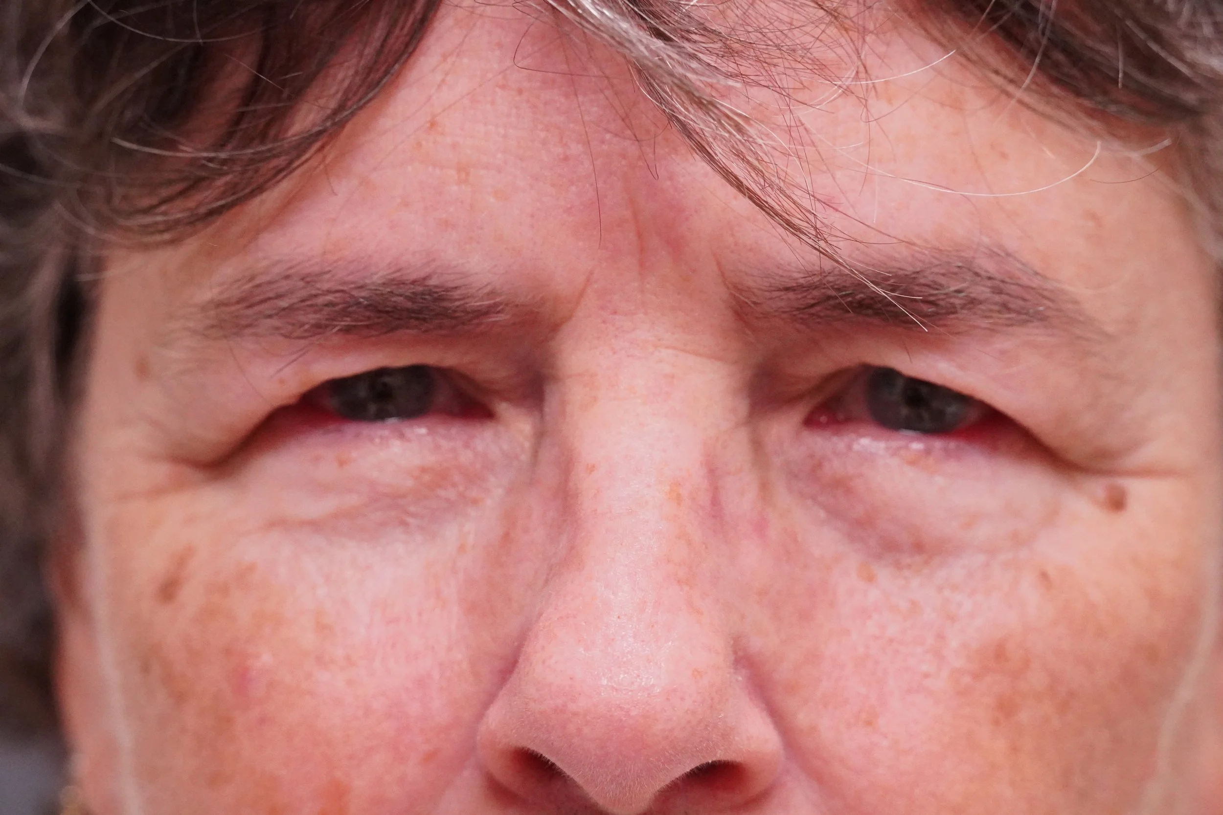 ms-Blepharoplasty-before-7