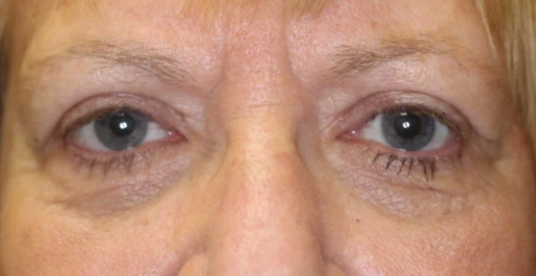Blepharoplasty & Ptosis Repair After 4