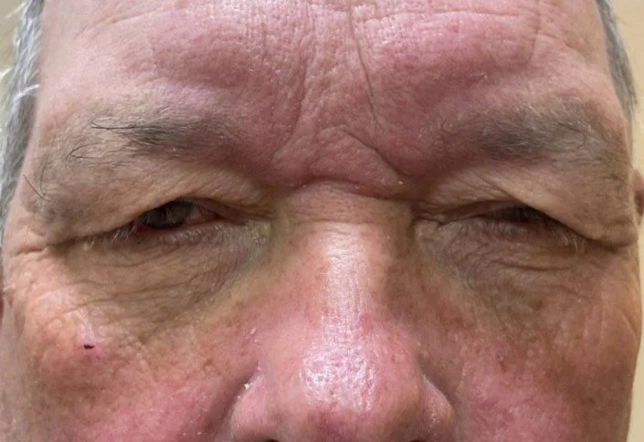 ms-Blepharoplasty-before-1