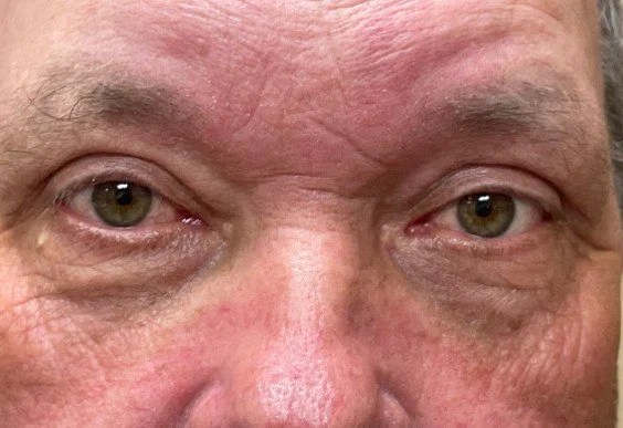 ms-Blepharoplasty-after-2