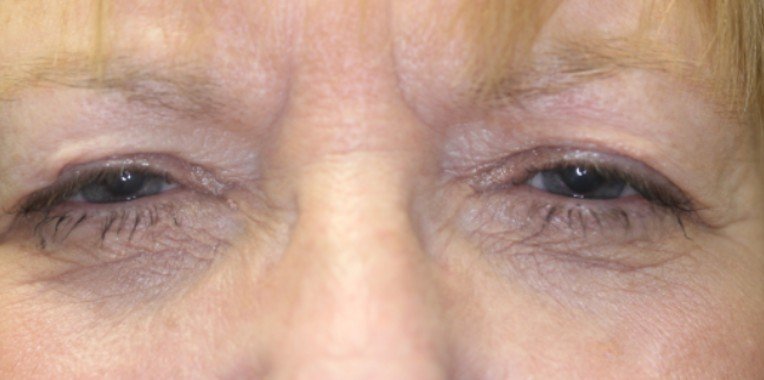 Blepharoplasty & Ptosis Repair Before 3