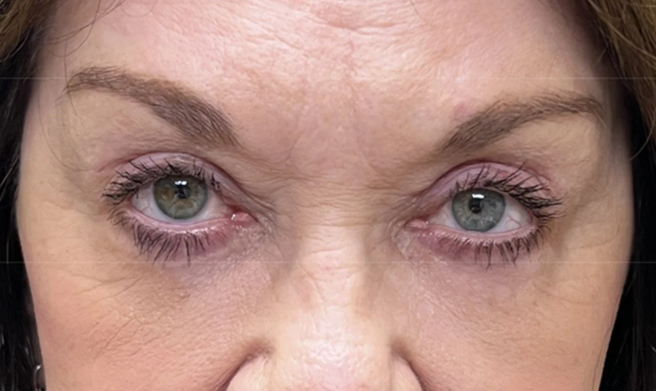 Ptosis Repair & Brow Lift After 2