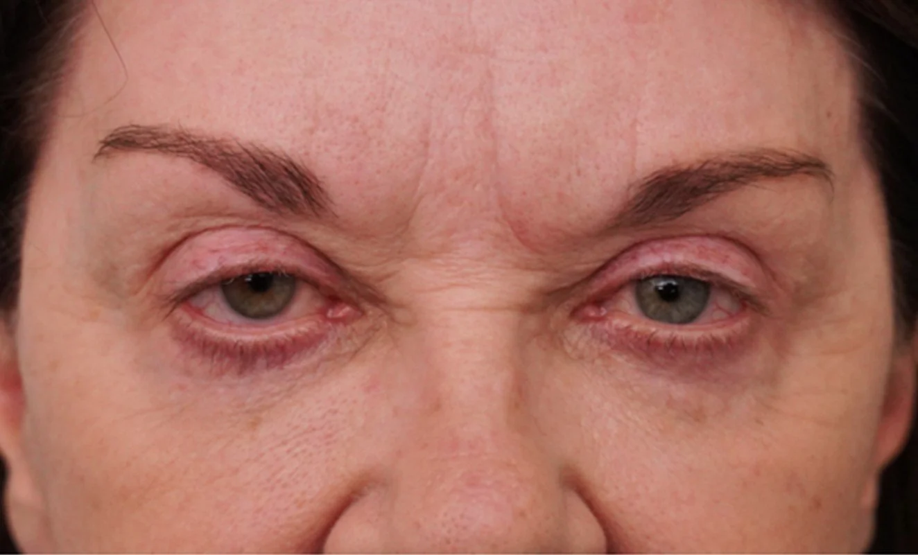 Ptosis Repair & Brow Lift Before 1