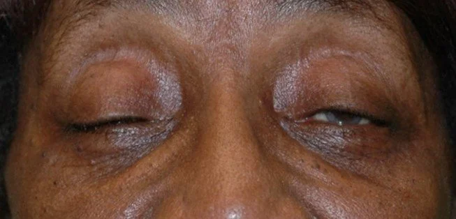 Ptosis Repair Before 3