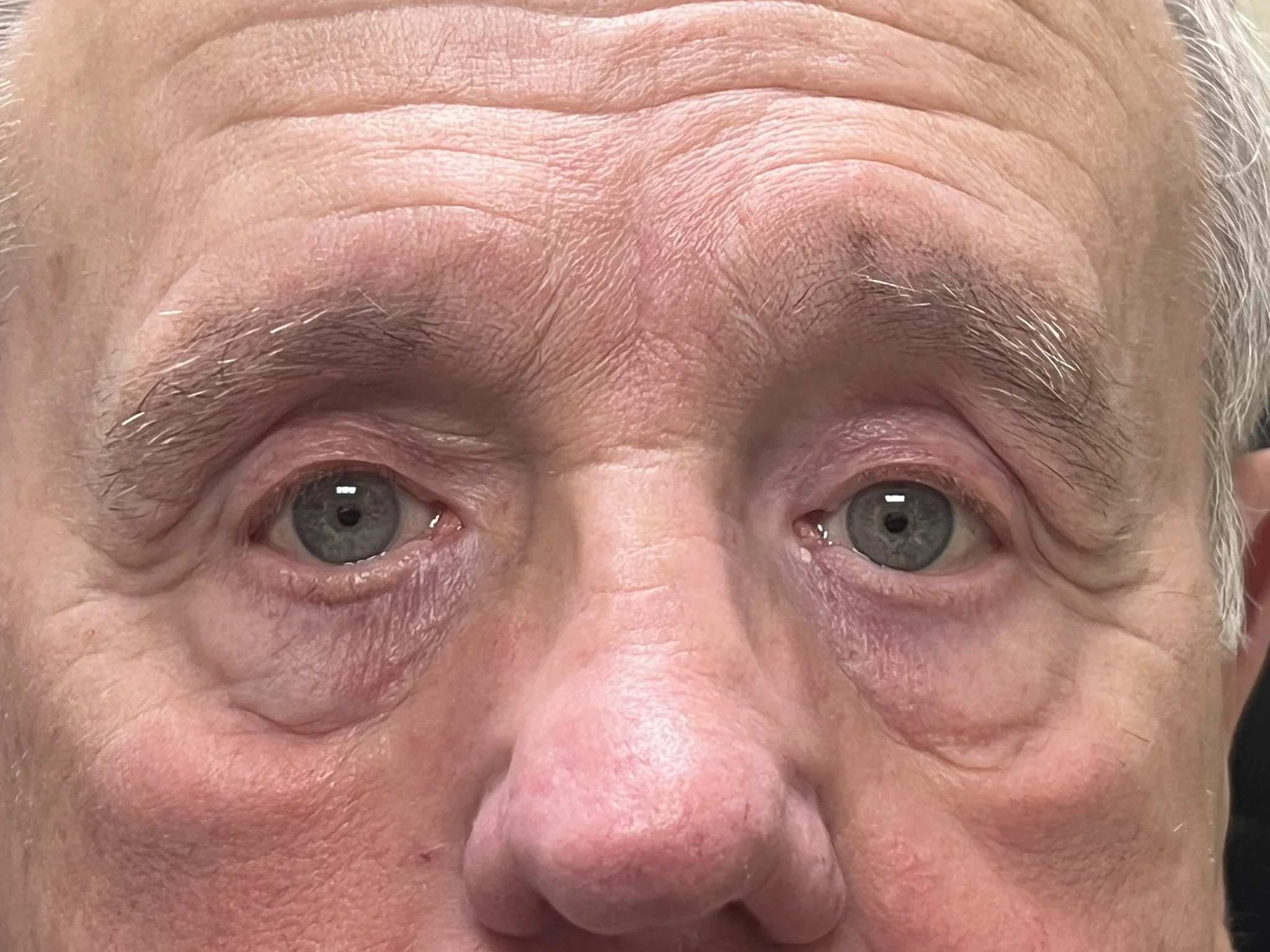 Blepharoplasty & Ptosis Repair After 2