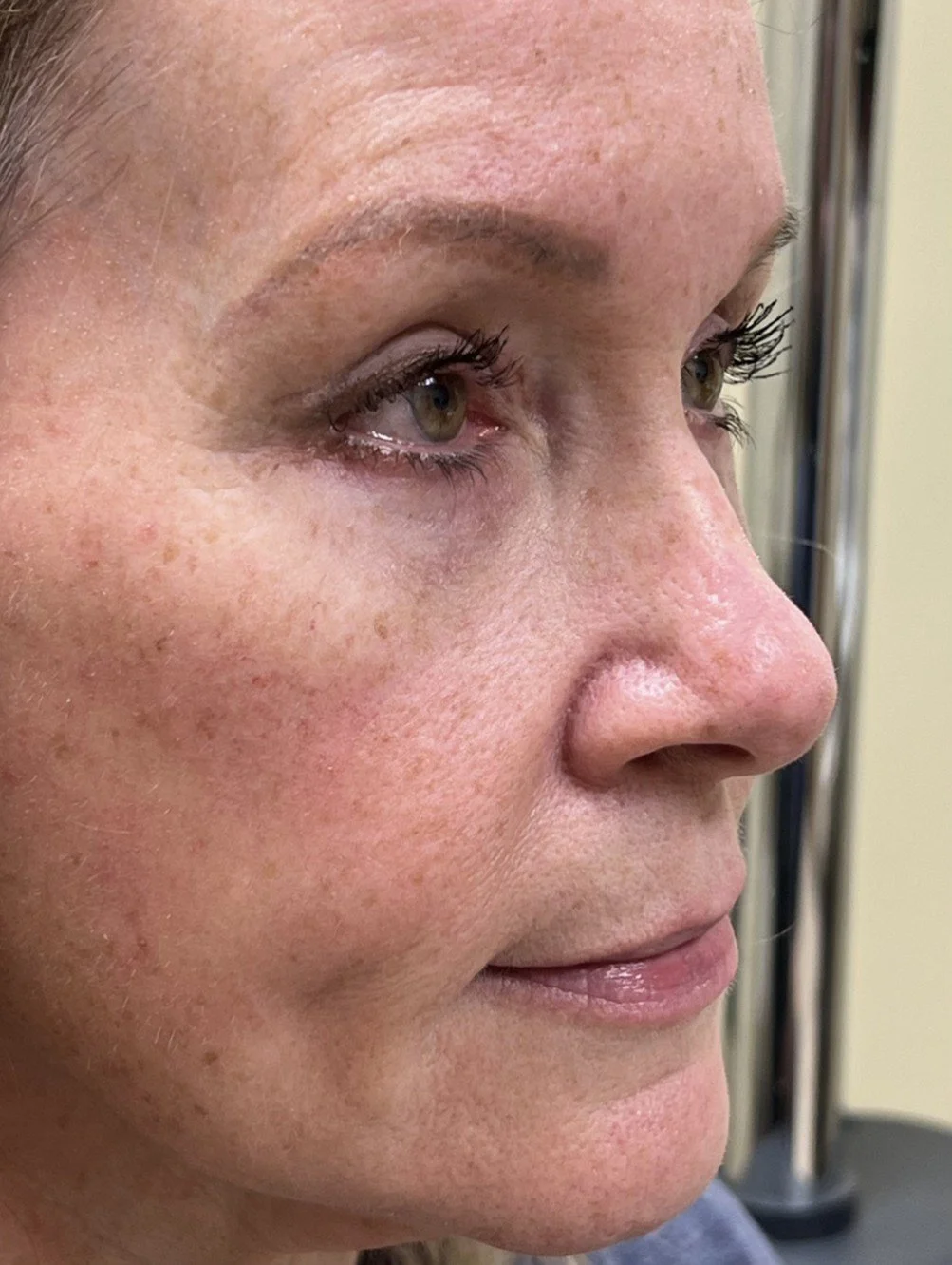ms-Blepharoplasty-after-6