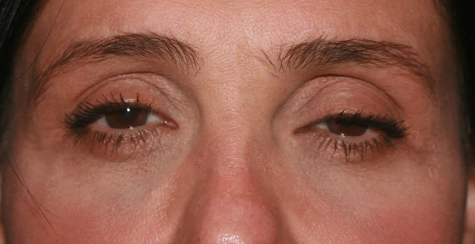 Ptosis Repair-Before-1