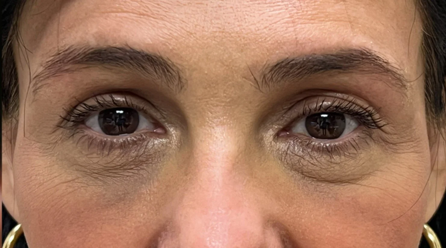 Ptosis Repair After 2