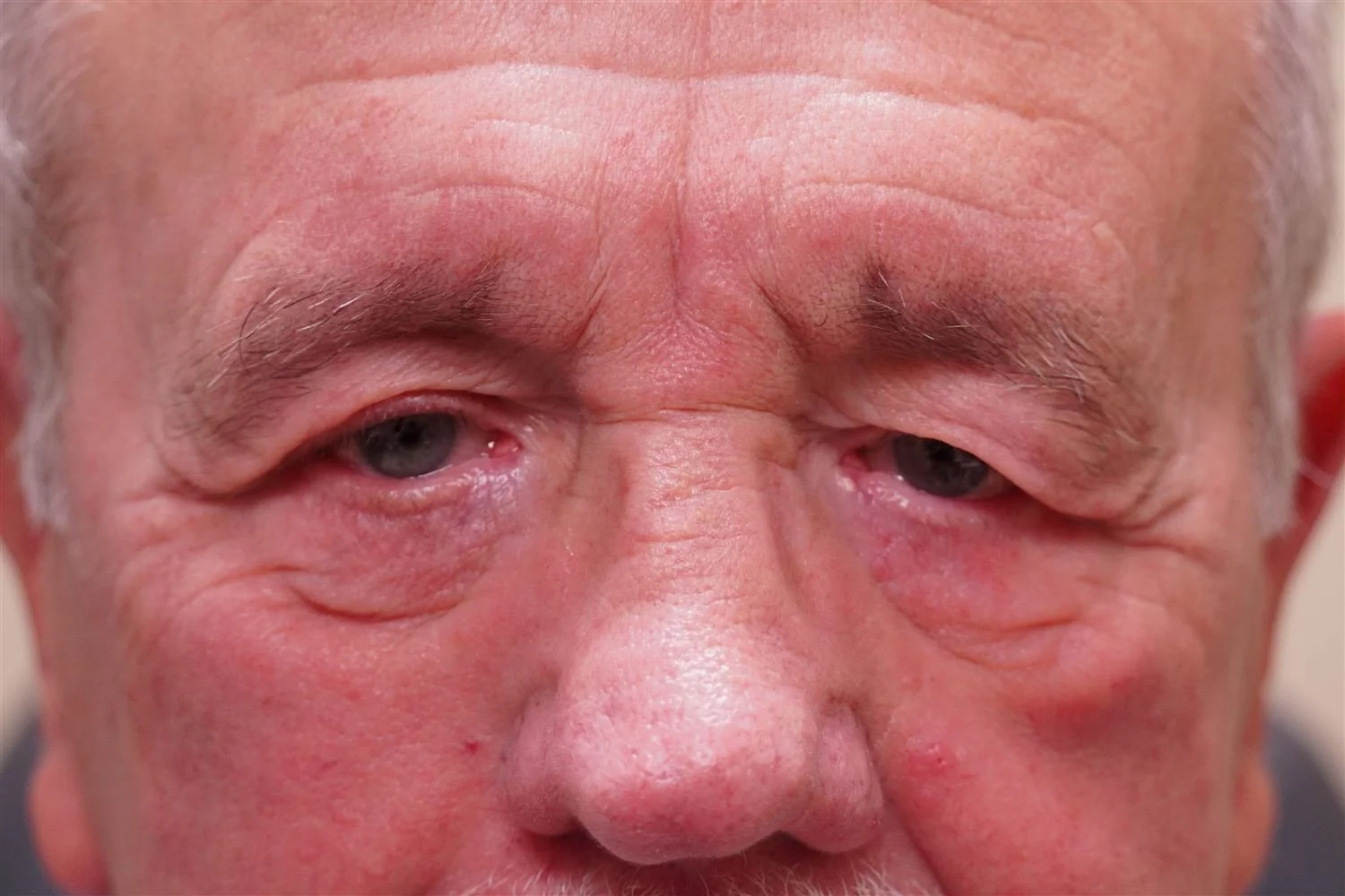 Blepharoplasty & Ptosis Repair Before 1