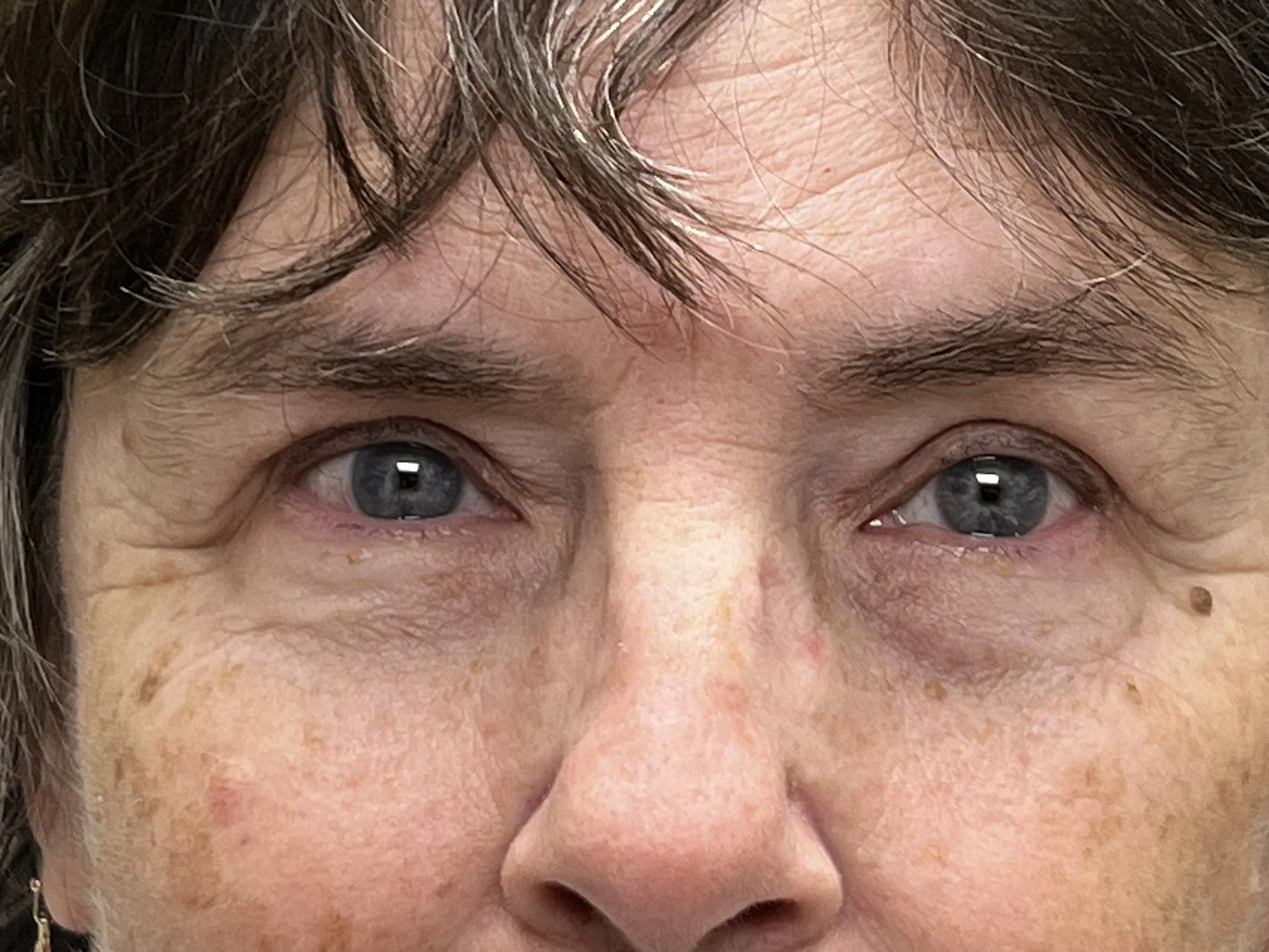 ms-Blepharoplasty-after-8