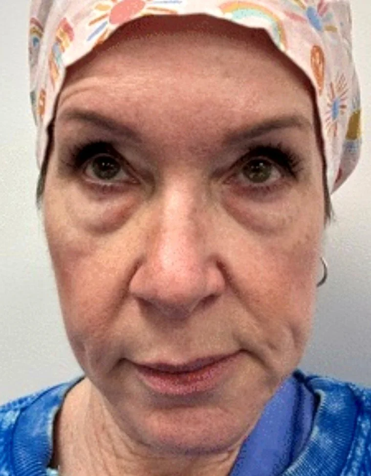 ms-Blepharoplasty-before-5