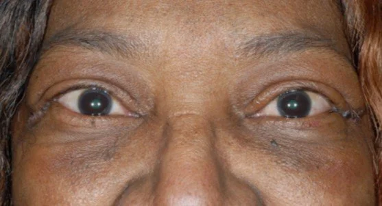 eyelid retraction repair after 1
