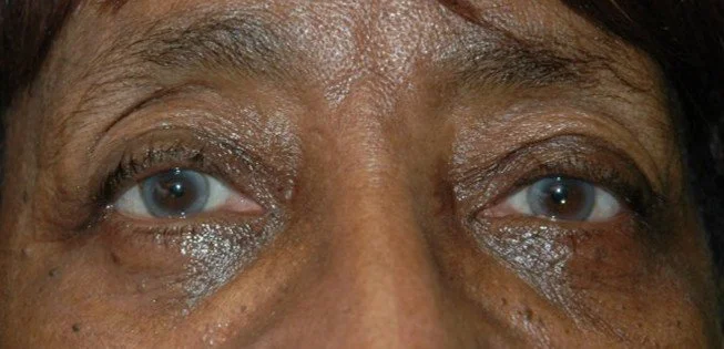 Ptosis Repair After 4