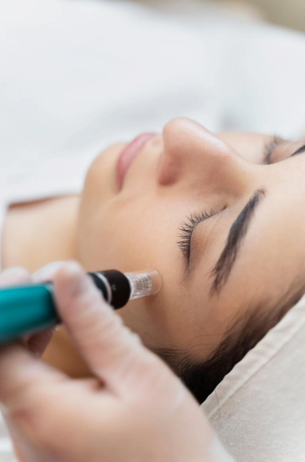 Microneedling skin rejuvenation treatment at Wolf Acupuncture Portland Oregon