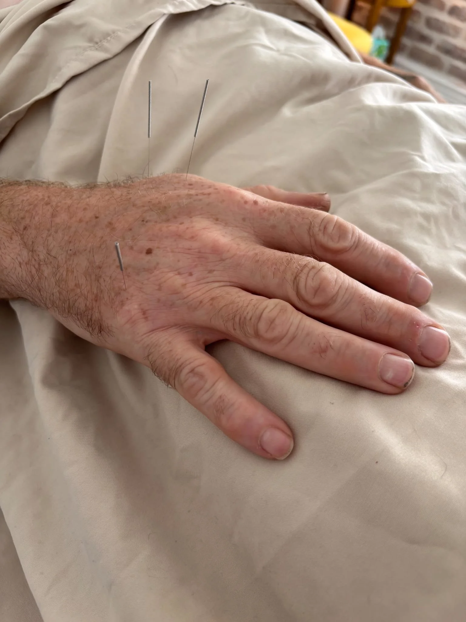 A person's hand lies on a beige fabric, with several acupuncture needles inserted into the hand.