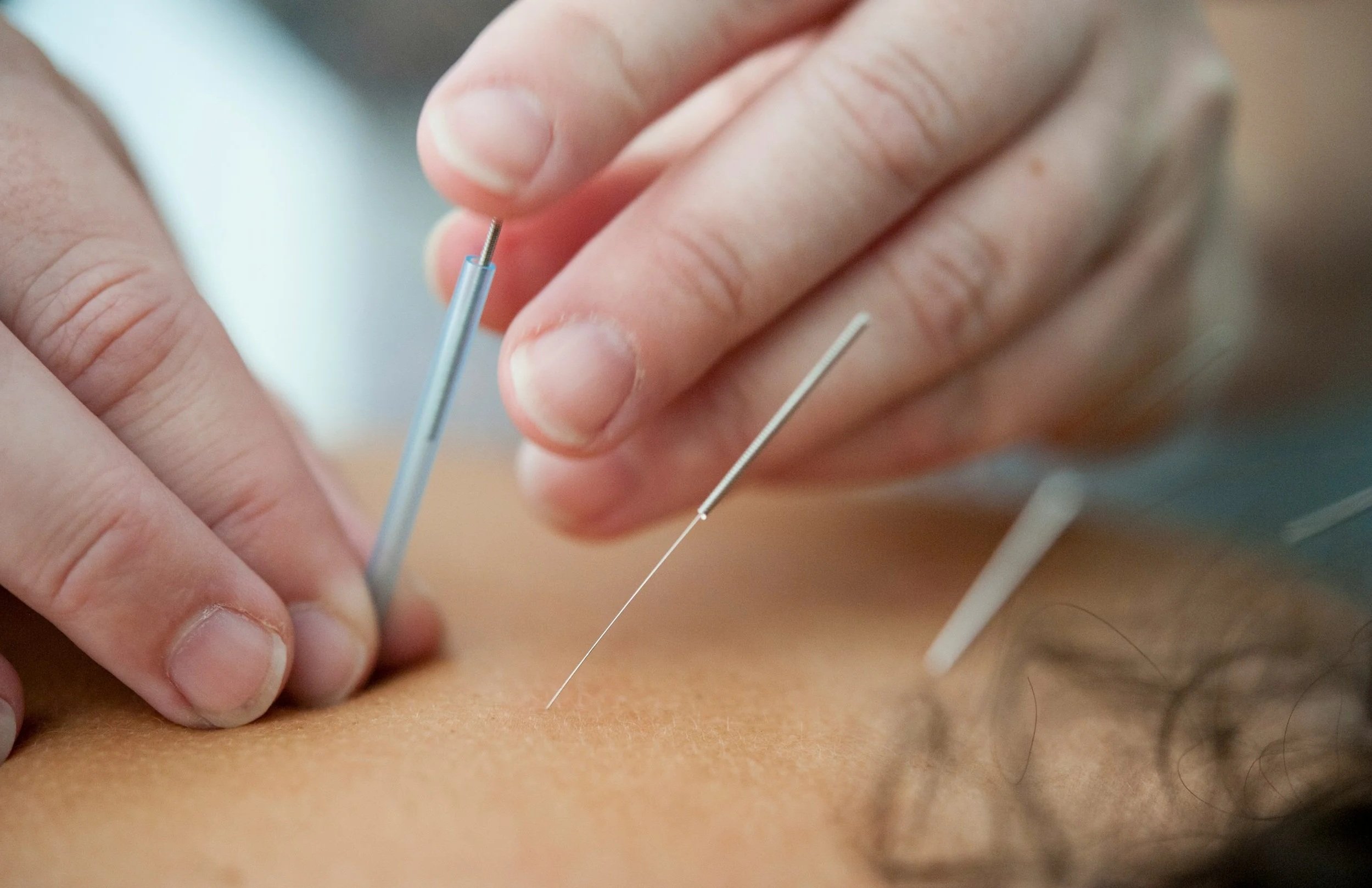 Close-up of a person receiving acupuncture, with thin needles inserted into their skin