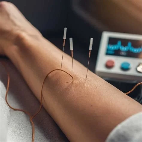 A person's arm undergoing acupuncture treatment with three acupuncture needles inserted into the skin, connected to a machine in the background.