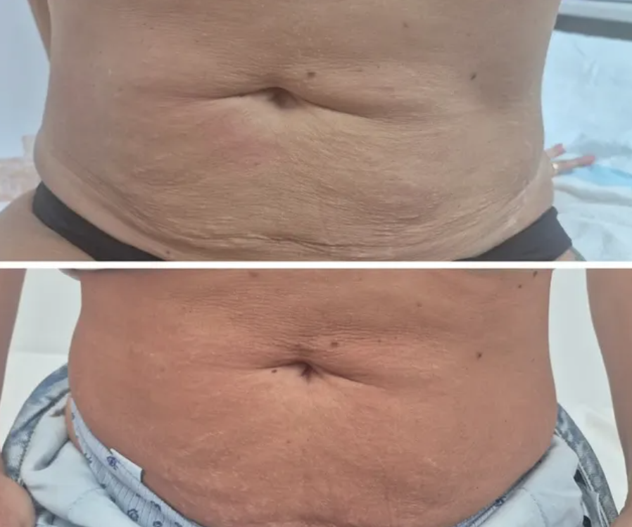 One Hifu + One EMS Treatment to abdomen