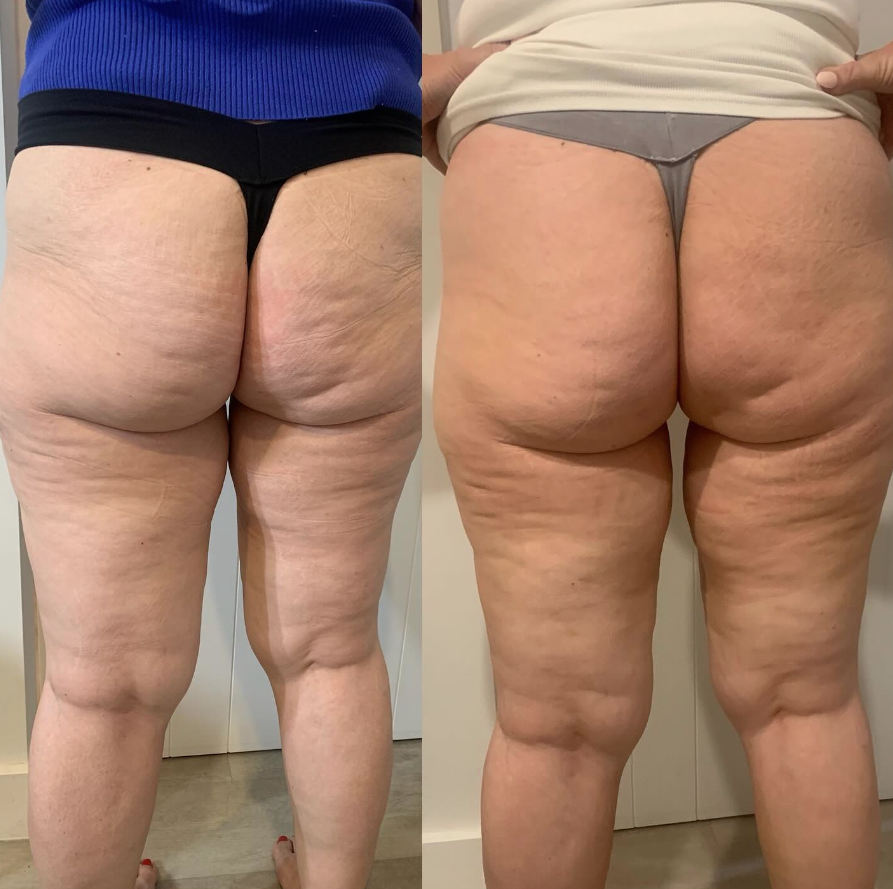Before and AFTER X4 Ems Treatments to Buttocks