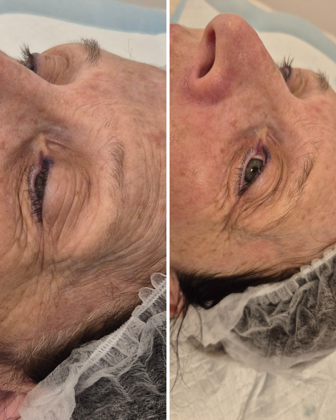 Before & 12 Weeks Post HIFU Treatment - Forehead / Temple Area