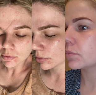 Close-up of a woman's face showing different stages of skin improvement, focused on acne injury healing.