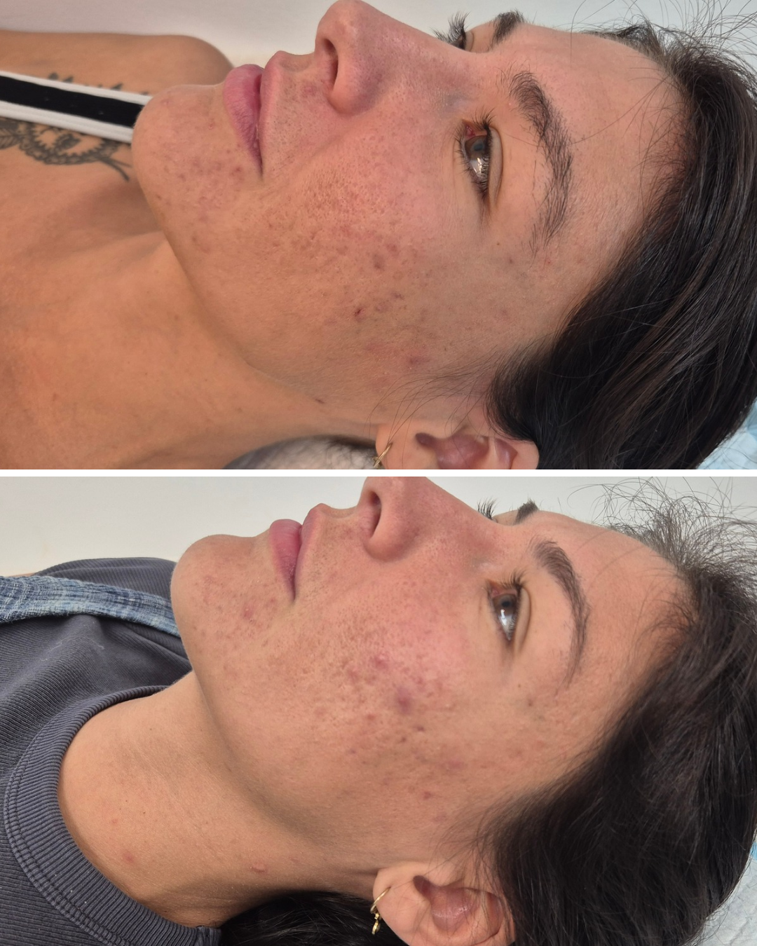 Before and After a Series of Treatments including microdermabrasion