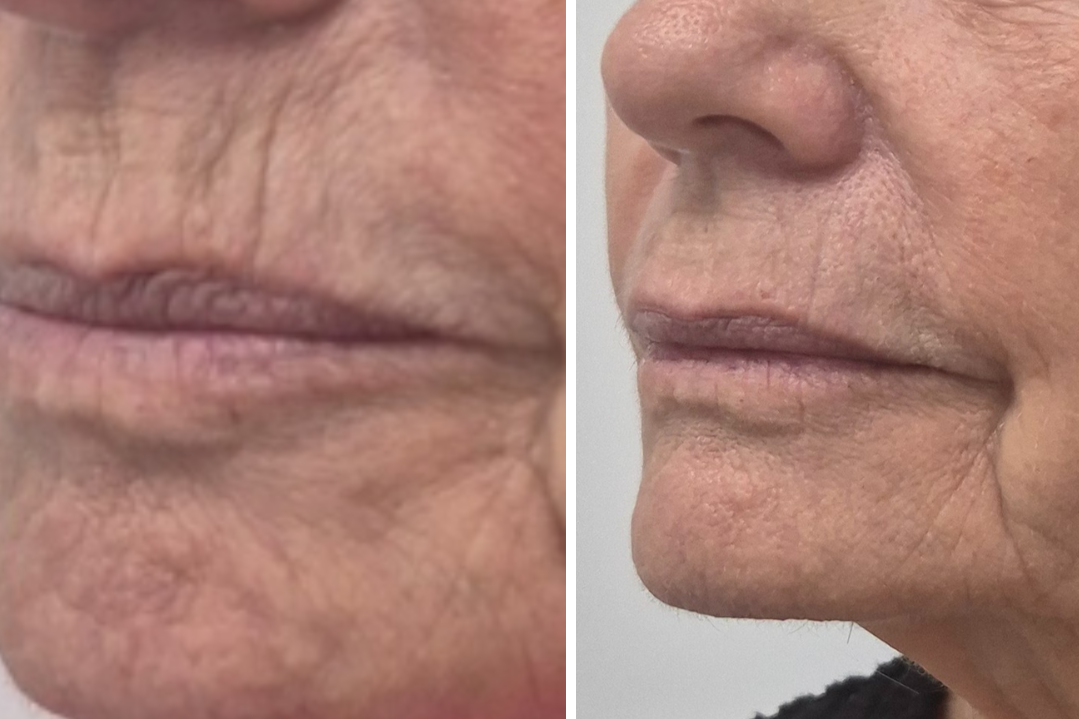 Before & 12 Weeks Post HIFU Treatment - Focus on Top Lip Area