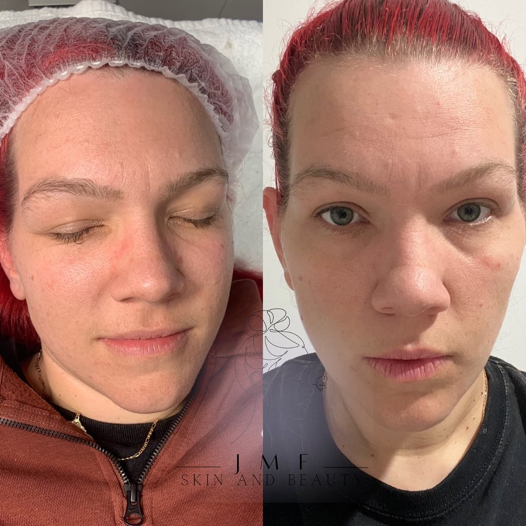 Comparison photo of a woman with red hair before and after a skincare treatment, showing improvements in skin texture and clarity.