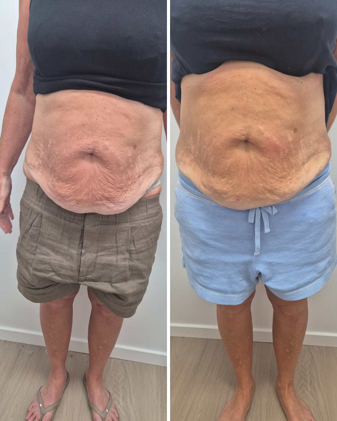 Two Sessions of Fat Freezing in conjuction with EMS
