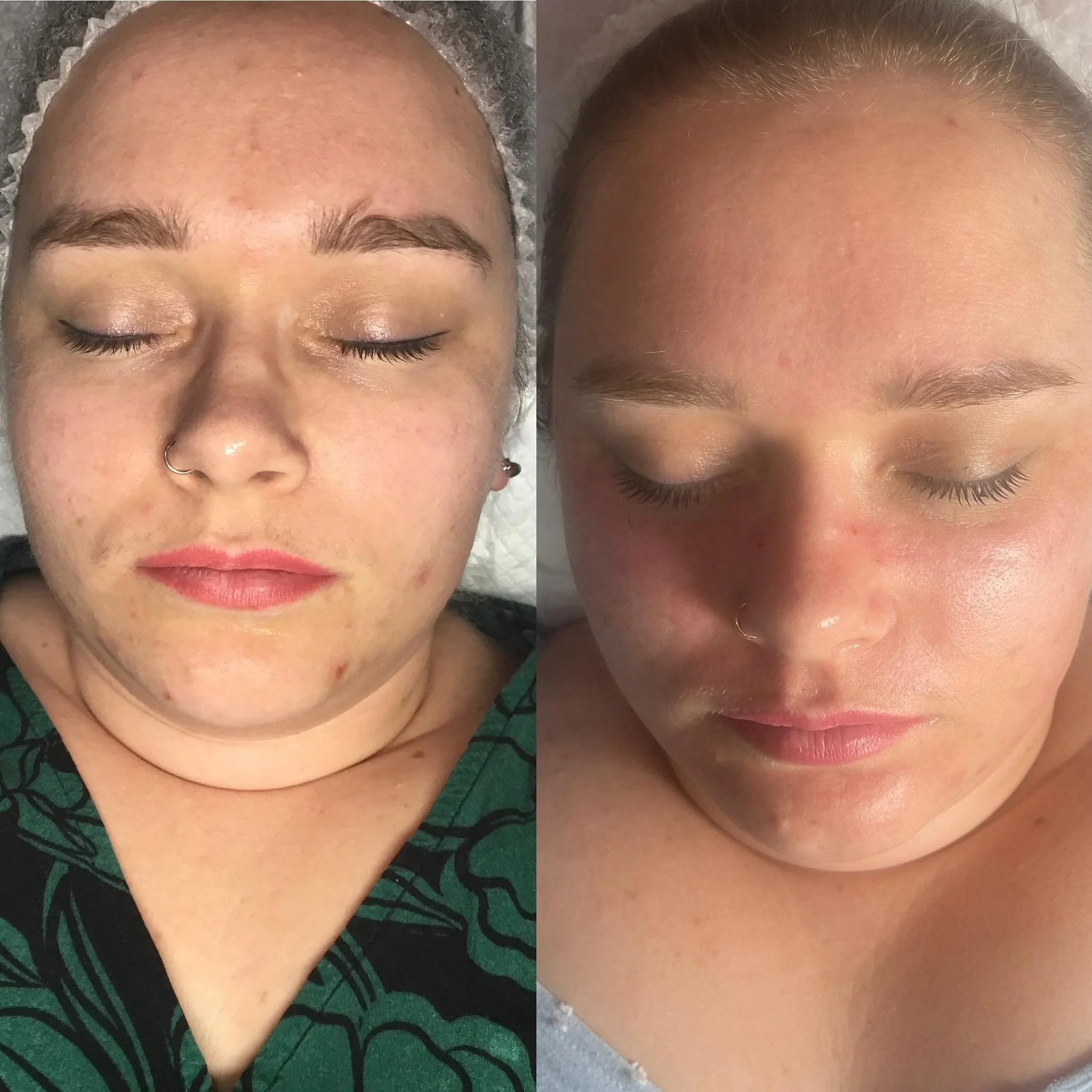 Side-by-side comparison of a woman before and after skincare treatment, showing improved skin clarity and reduced blemishes.