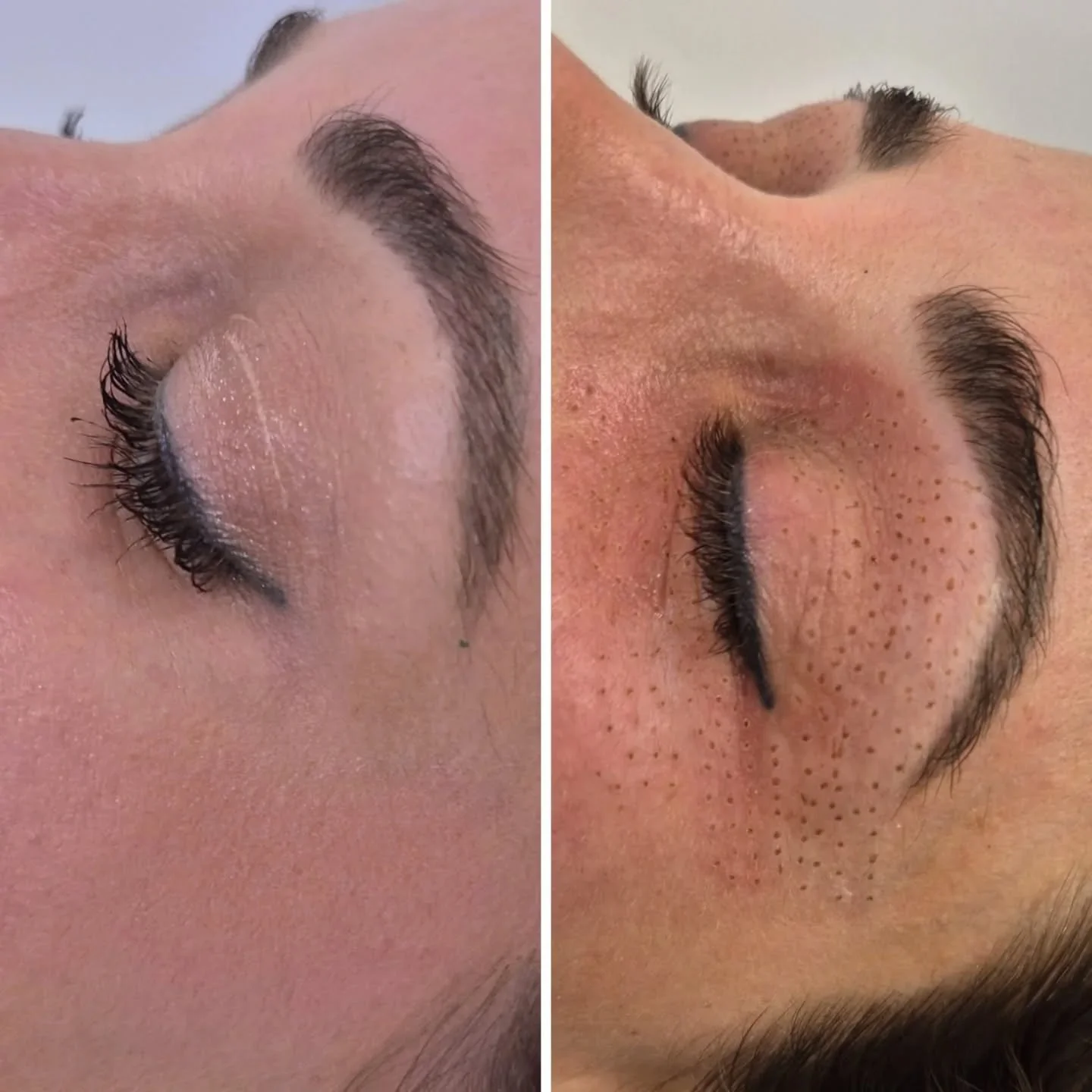 BEFORE AND IMMEDIATELY AFTER EYELID