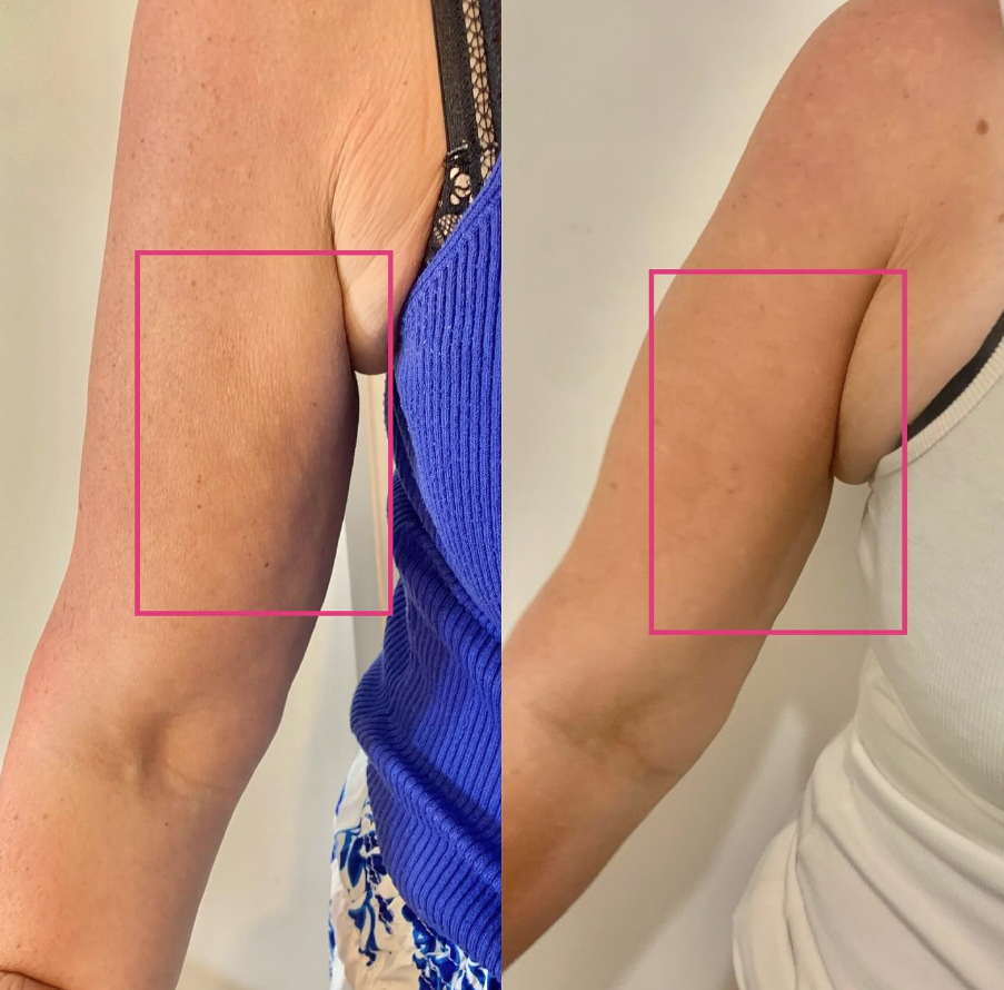 Before & After 4 EMS Sessions to Arm